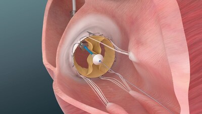 Trisol Medical Announces Positive Results from U.S. Early Feasibility Study of Its Transcatheter Tricuspid Valve Replacement System